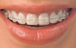 Керамические брекеты - комфортное выравнивание зубов